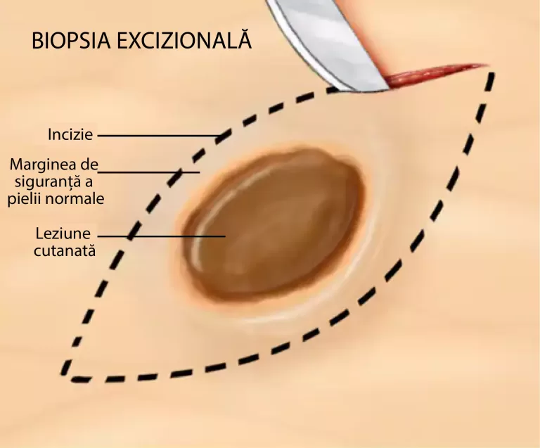 biopsia excizionala