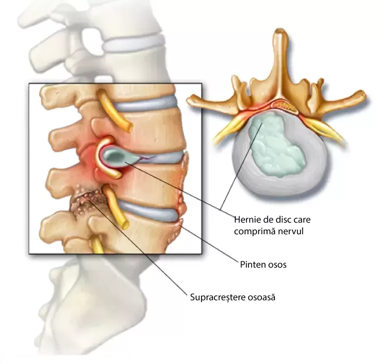 hernia de disc