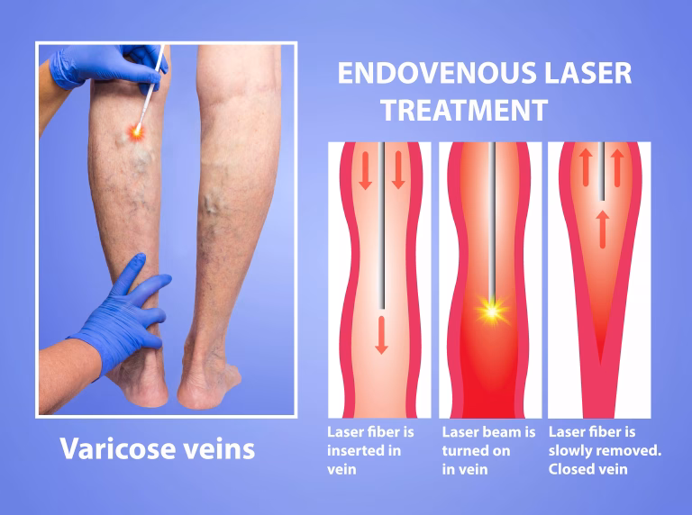 Blog-Chirurgie Generala-Diferenta_laser_endovenos_vs_chirurgie_varice2
