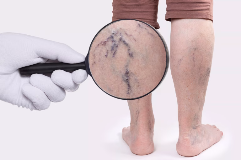 Blog-Chirurgie Generala-Scleroterapie_cu_spuma