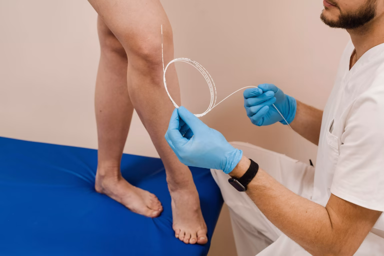 Blog-Chirurgie Generala- Tratamentul_varicelor_cu_laser_endovenos