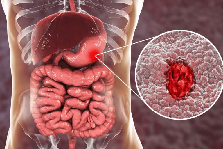ulcer-peptic