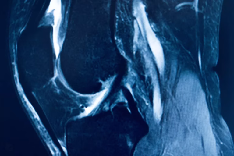 rupturi_ligamente