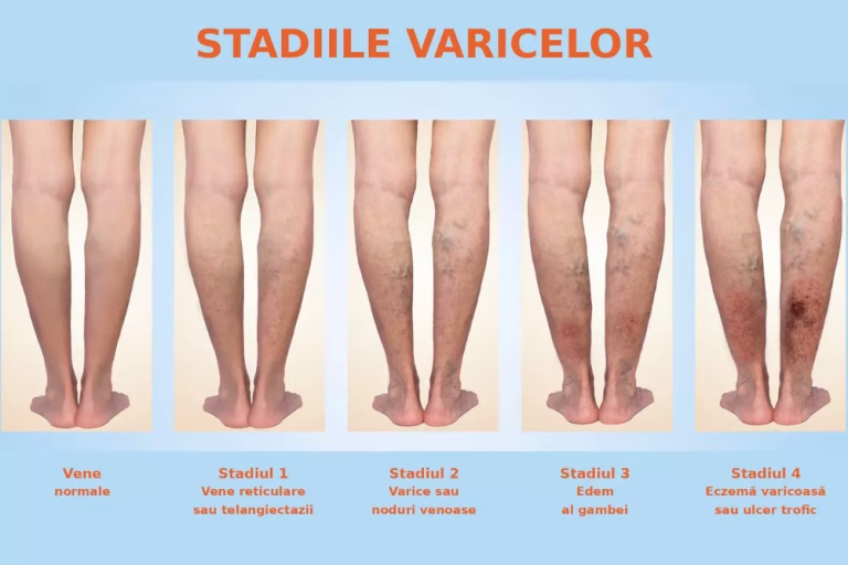 Clasificarea Varicelor (1)