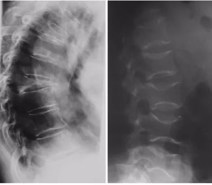 Fractură Fragilitate Vertebrală